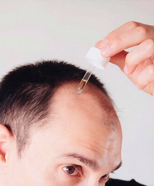 Bald man applying hair loss treatment to scalp